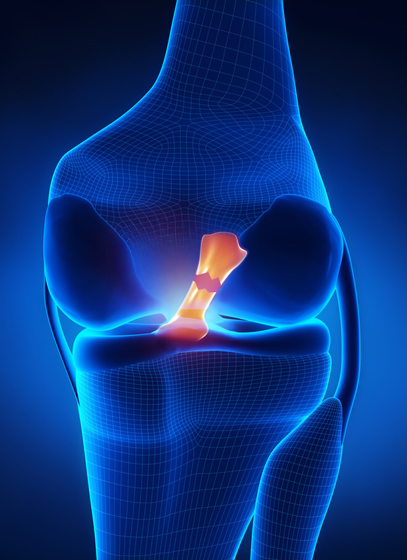 graphic of a torn ACL