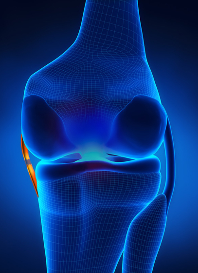 graphic of a torn MCL