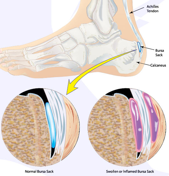 Achilles Bursitis Causes, Symptoms, Treatment