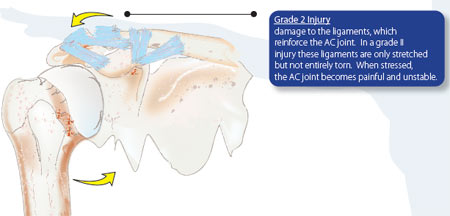 AC Joint Separation Grade 2