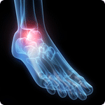 Broken Ankle