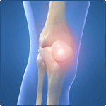 Bursitis of the Knee