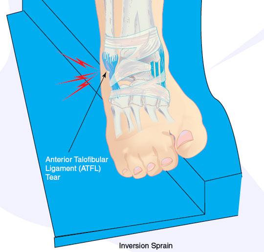 What ankle support is right for my sprained ankle?