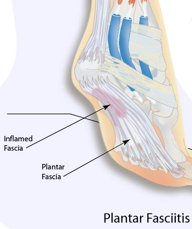 Plantar Fasciitis - Experts in Heel pain with Advanced Treatment
