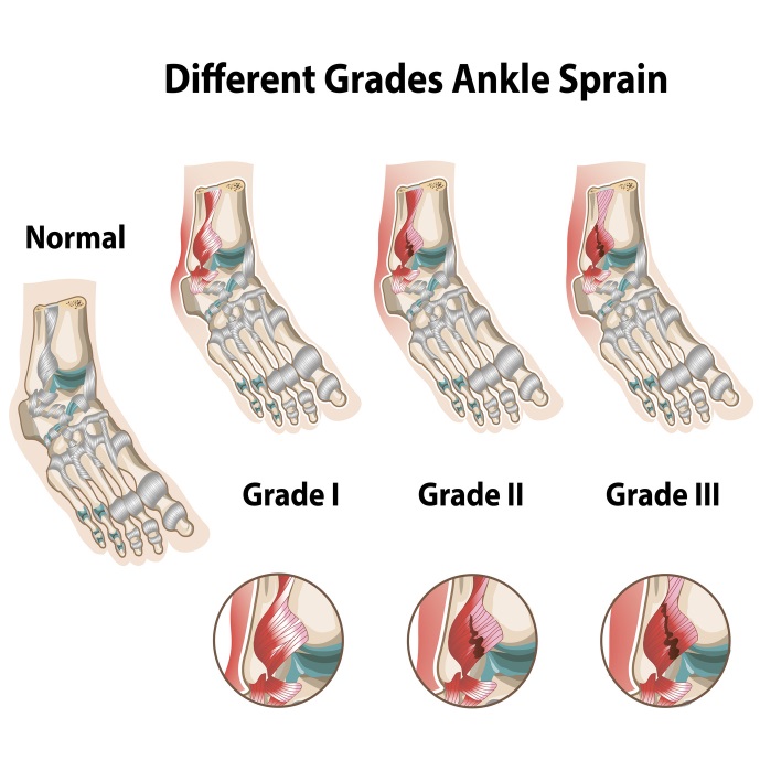 Ankle Sprain Grades and Corresponding Treatments: LA Orthopaedic