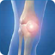 Patella Dislocations